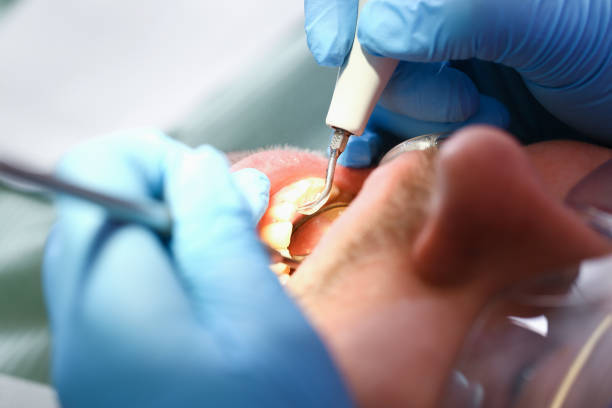 Best Emergency Dentist for Lost Fillings or Crowns in Surrey, ND